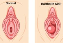 Bartholin Kisti bartholin kisti
