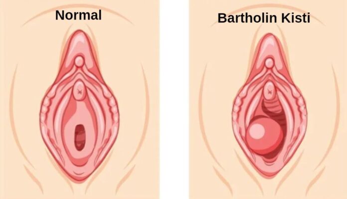 bartholin kisti